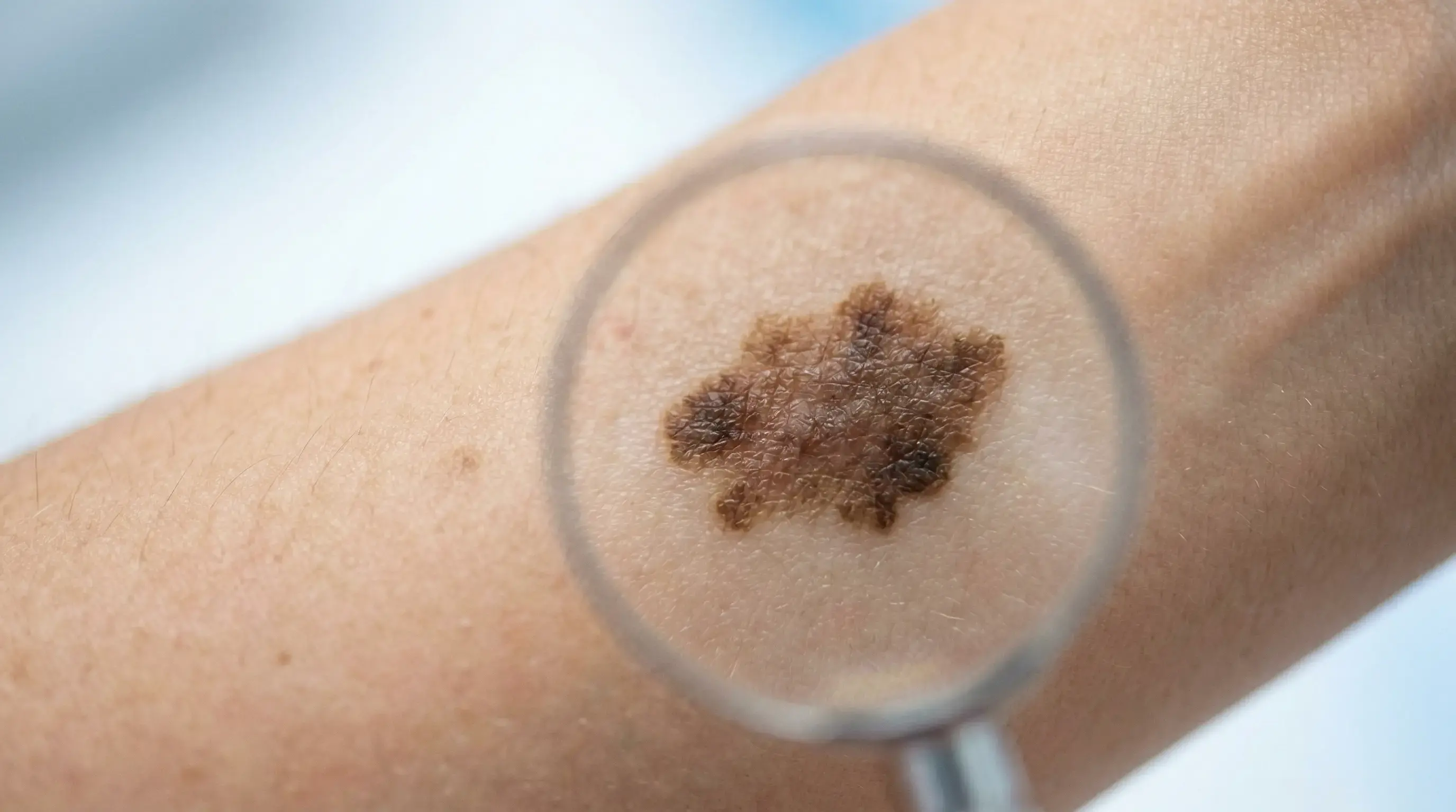 Dəri Xərçəngi Nədir? Əlamətləri, Səbəbləri və Melanoma Haqqında Hər Şey